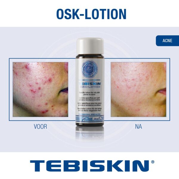 TEBISKIN® OSK-LOTION    Losjonas odai linkusiai į aknę lokaliam naudojimui - Image 2